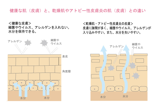 健康な皮膚とアトピー性皮膚炎の肌の違い